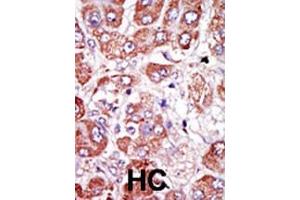 Formalin-fixed and paraffin-embedded human cancer tissue reacted with the primary antibody, which was peroxidase-conjugated to the secondary antibody, followed by DAB staining. (PLAUR 抗体  (AA 136-166))