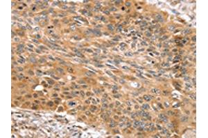 The image on the left is immunohistochemistry of paraffin-embedded Human esophagus cancer tissue using ABIN7131123(SNX11 Antibody) at dilution 1/30, on the right is treated with fusion protein. (SNX11 抗体)