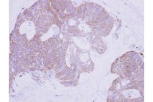 IHC-P Image Immunohistochemical analysis of paraffin-embedded human colon carcinoma, using PTER, antibody at 1:500 dilution. (PTER 抗体)