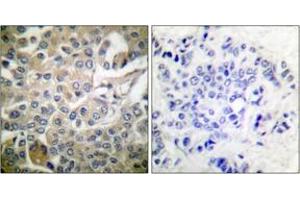Immunohistochemistry analysis of paraffin-embedded human breast carcinoma tissue, using Rac1/CDC42 (Ab-71) Antibody. (RAC1+CDC42 (AA 38-87) 抗体)