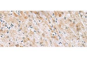 Immunohistochemistry of paraffin-embedded Human liver cancer tissue using GPC2 Polyclonal Antibody at dilution of 1:40(x200) (GPC2 抗体)