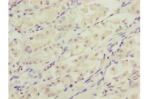 Immunohistochemistry of paraffin-embedded human gastric cancer using ABIN7150132 at dilution of 1:100 (DDIT3 抗体  (AA 1-169))