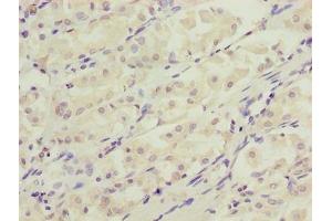 Immunohistochemistry of paraffin-embedded human gastric cancer using ABIN7150132 at dilution of 1:100 (DDIT3 抗体  (AA 1-169))