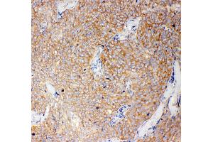 Anti-Caspase-12 antibody, IHC(P) IHC(P): Human Lung Cancer Tissue (Caspase 12 抗体  (N-Term))