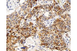 Immunohistochemistry analysis of paraffin-embedded human lung cancer using CD107b Polyclonal Antibody at dilution of 1:300. (LAMP2 抗体)