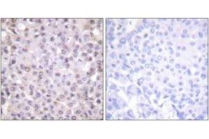 Immunohistochemistry analysis of paraffin-embedded human breast carcinoma tissue, using NCoR1 Antibody. (NCOR1 抗体  (AA 51-100))