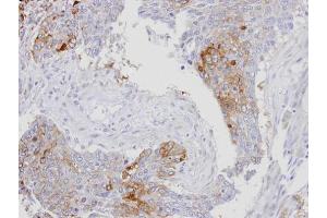 IHC-P Image Immunohistochemical analysis of paraffin-embedded human lung SCC, using RanBP16, antibody at 1:100 dilution. (Exportin 7 抗体  (C-Term))