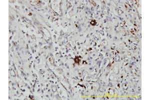 Immunoperoxidase of monoclonal antibody to ORM1 on formalin-fixed paraffin-embedded human stomach carcinoma tissue. (ORM1 抗体  (AA 18-201))