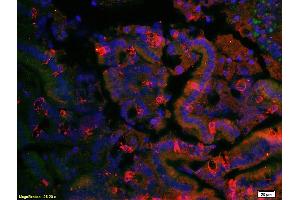 Formalin-fixed and paraffin embedded human cervical carcinoma labeled with Anti- LONP1 Polyclonal Antibody, Unconjugated (ABIN705806) at 1:200 followed by conjugation to the secondary antibody (LONP1 抗体  (AA 361-460))