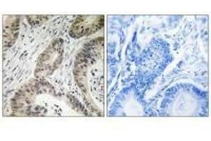 Immunohistochemistry analysis of paraffin-embedded human colon carcinoma tissue using TUT1 antibody. (TUT1 抗体)