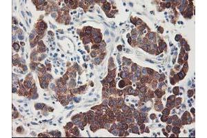 Immunohistochemical staining of paraffin-embedded Carcinoma of Human lung tissue using anti-FDFT1 mouse monoclonal antibody. (FDFT1 抗体)