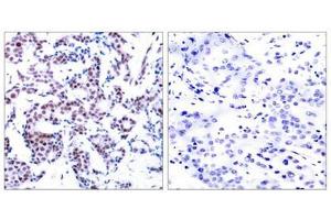 Immunohistochemical analysis of paraffin-embedded human breast carcinoma tissue using JunB(Phospho-Ser259) Antibody(left) or the same antibody preincubated with blocking peptide(right). (JunB 抗体  (pSer259))