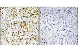 Immunohistochemistry analysis of paraffin-embedded human liver carcinoma tissue, using LEG4 Antibody. (GAL4 抗体  (AA 61-110))