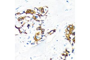 Immunohistochemistry of paraffin-embedded Human lung cancer using  Rabbit pAb (ABIN6131176, ABIN6136646, ABIN6136647 and ABIN6222857) at dilution of 1:100 (40x lens). (AGR2 抗体  (AA 21-175))
