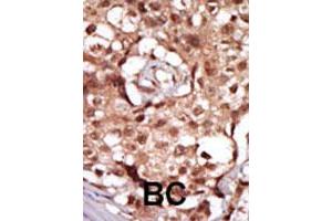 Formalin-fixed and paraffin-embedded human cancer tissue reacted with RIPK2 polyclonal antibody  , which was peroxidase-conjugated to the secondary antibody, followed by AEC staining. (RIPK2 抗体  (C-Term))