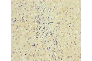 Immunohistochemistry of paraffin-embedded human liver cancer using ABIN7159631 at dilution of 1:100 (MCCC1 抗体  (AA 526-725))