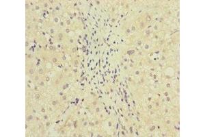 Immunohistochemistry of paraffin-embedded human liver cancer using ABIN7159631 at dilution of 1:100