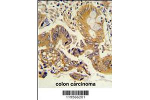 Formalin-fixed and paraffin-embedded human colon carcinoma reacted with CLNS1A Antibody , which was peroxidase-conjugated to the secondary antibody, followed by DAB staining. (CLNS1A 抗体  (AA 148-176))