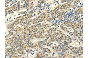 The image on the left is immunohistochemistry of paraffin-embedded Human liver cancer tissue using ABIN7130215(MED16 Antibody) at dilution 1/20, on the right is treated with fusion protein. (MED16 抗体)