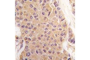 IHC analysis of FFPE human breast carcinoma tissue stained with TGF Beta 2 antibody (TGFB2 抗体  (AA 277-306))