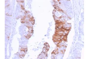 Formalin-fixed, paraffin-embedded human Colon Carcinoma stained with Cytokeratin 20 Recombinant Rabbit Monoclonal Antibody (KRT20/3129R). (Recombinant KRT20 抗体  (AA 196-323))
