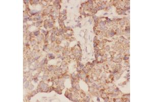 Anti-FSH beta Picoband antibody,  IHC(P): Human Mammary Cancer Tissue (FSHB 抗体  (AA 19-129))