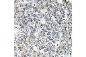 Immunohistochemistry of paraffin-embedded human liver cancer using FUC Rabbit pAb (ABIN6127916, ABIN6140809, ABIN6140811 and ABIN6215812) at dilution of 1:200 (40x lens). (FUCA2 抗体  (AA 118-467))