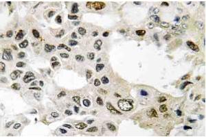 Immunohistochemistry (IHC) analyzes of eIF3D antibody staining in Paraffin-Embedded Human breast carcinoma tissue. (EIF3D 抗体)