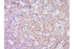 Paraformaldehyde-fixed, paraffin embedded human liver carcinoma, Antigen retrieval by boiling in sodium citrate buffer (pH6) for 15min, Block endogenous peroxidase by 3% hydrogen peroxide for 30 minutes, Blocking buffer (BSA or normal goat serum) at 37°C for 20min, Antibody incubation with LIPC Polyclonal Antibody, Unconjugated  at 1:200 overnight at 4°C, followed by a conjugated secondary (sp-0023) for 20 minutes and DAB staining. (LIPC 抗体  (AA 301-400))
