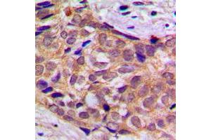 Immunohistochemical analysis of 14-3-3 theta staining in human prostate cancer formalin fixed paraffin embedded tissue section.