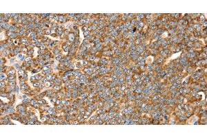 Immunohistochemistry of paraffin-embedded Human cervical cancer tissue using SLC8A3 Polyclonal Antibody at dilution 1:35 (SLC8A3 抗体)
