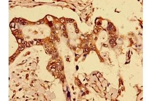 Immunohistochemistry of paraffin-embedded human breast cancer using ABIN7150562 at dilution of 1:100 (DOK1 抗体  (AA 1-481))