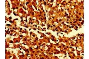 Immunohistochemistry of paraffin-embedded human breast cancer using ABIN7146907 at dilution of 1:100 (CARD14 抗体  (AA 249-523))