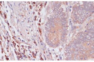 Immunohistochemistry of paraffin-embedded Human colon carcinoma using IFNAR2 Polyclonal Antibody at dilution of 1:100 (40x lens). (IFNAR2 抗体)