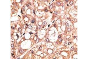 IHC analysis of FFPE human hepatocarcinoma stained with the LSD1 antibody (LSD1 抗体  (AA 457-490))