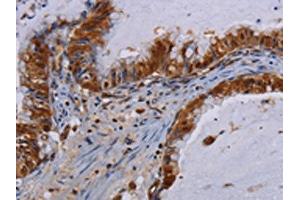 The image on the left is immunohistochemistry of paraffin-embedded Human esophagus cancer tissue using ABIN7130211(MECP2 Antibody) at dilution 1/60, on the right is treated with fusion protein. (MECP2 抗体)