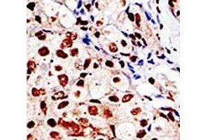 IHC analysis of FFPE human breast carcinoma tissue stained with the SUMO antibody (SUMO1 抗体  (AA 52-79))
