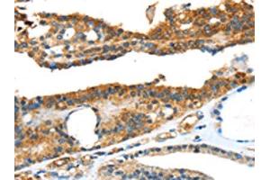 The image on the left is immunohistochemistry of paraffin-embedded Human thyroid cancer tissue using ABIN7131111(SNAI3 Antibody) at dilution 1/20, on the right is treated with fusion protein. (SNAI3 抗体)