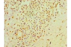 Immunohistochemistry of paraffin-embedded human breast cancer using ABIN7162034 at dilution of 1:100 (NXNL1 抗体  (AA 1-200))