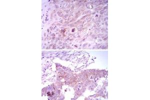 Immunohistochemical analysis of paraffin-embedded human lung cancer tissues (upper) and ovarian cancer tissues (bottom) using FOXD3 monoclonal antibody, clone 5G9  with DAB staining.