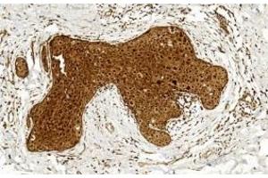 Immunohistochemical analysis of paraffin-embedded Human Breast cancer section using Pink1 (ABIN391538 and ABIN2841489).
