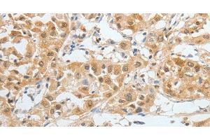 Immunohistochemistry of paraffin-embedded Human liver cancer tissue using BPIFB2 Polyclonal Antibody at dilution 1:45 (BPIL1 抗体)