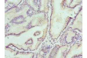 Immunohistochemistry of paraffin-embedded human prostate cancer using ABIN7157212 at dilution of 1:100 (Kallikrein 4 抗体  (AA 30-254))