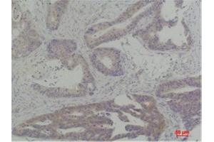 Immunohistochemistry (IHC) analysis of paraffin-embedded Human Breast Carcinoma using TBP Rabbit Polyclonal Antibody diluted at 1:200. (TBP 抗体)