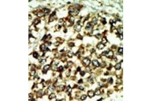 Formalin-fixed and paraffin-embedded human cancer tissue reacted with the primary antibody, which was peroxidase-conjugated to the secondary antibody, followed by DAB staining. (ATM 抗体  (C-Term))