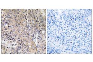Immunohistochemistry analysis of paraffin-embedded human lung carcinoma tissue using LAMP3 antibody. (LAMP3 抗体  (Internal Region))