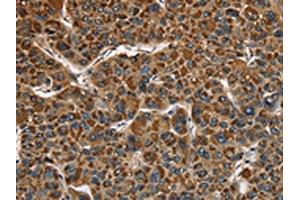 The image on the left is immunohistochemistry of paraffin-embedded Human liver cancer tissue using ABIN7128790(CAT Antibody) at dilution 1/40, on the right is treated with fusion protein. (Catalase 抗体)