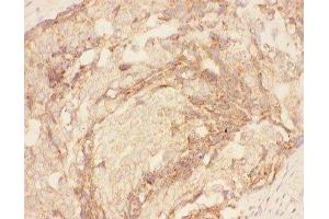 IHC-P: Eotaxin 3 antibody testing of human breast cancer tissue (CCL26 抗体  (AA 24-94))