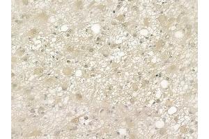 ABIN6257651 and ABIN6274369 at 1/100 staining human astrocytoma by IHC-P.
