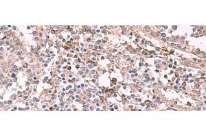 Immunohistochemistry of paraffin-embedded Human tonsil tissue using ADH1B Polyclonal Antibody at dilution of 1:55(x200) (ADH1B 抗体)